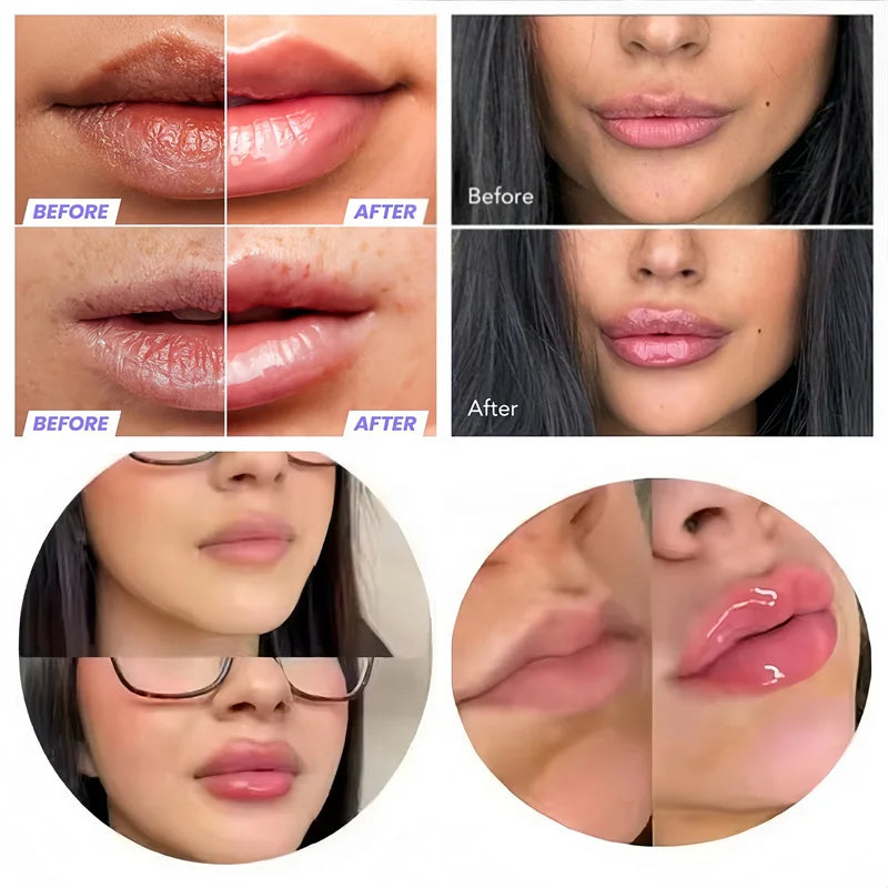 Auralis® Korean Juicy Lip Filler™